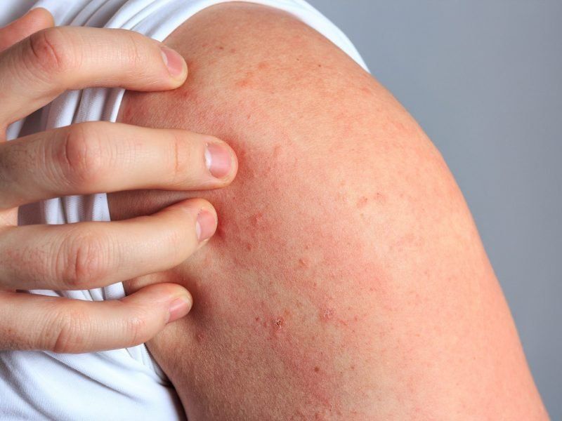 Dermatitis atópica: todo lo que tenés que saber de esta enfermedad crónica