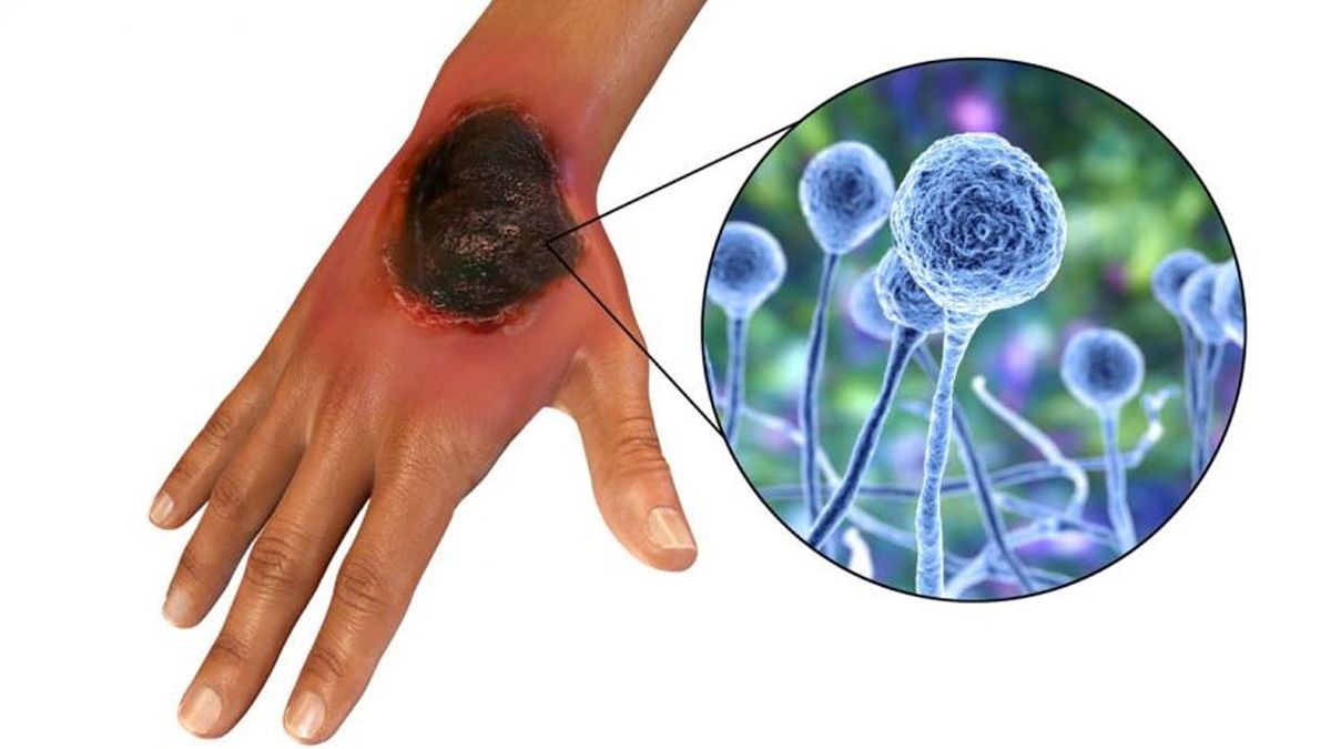 La mucormicosis es una enfermedad angioinvasiva grave, de progresión rápida, que es muy poco frecuente en la población general.