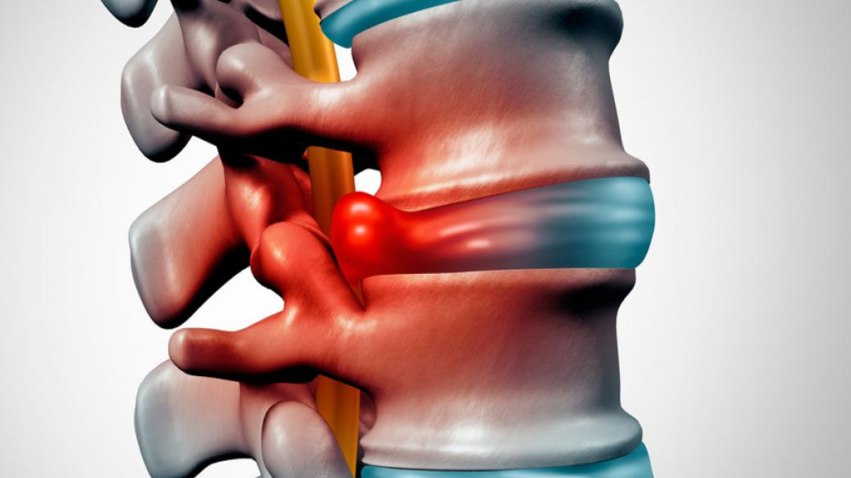 La hernia de disco lumbar hace referencia a un problema con uno de los amortiguadores cartilaginosos (discos) que se encuentran entre los huesos.