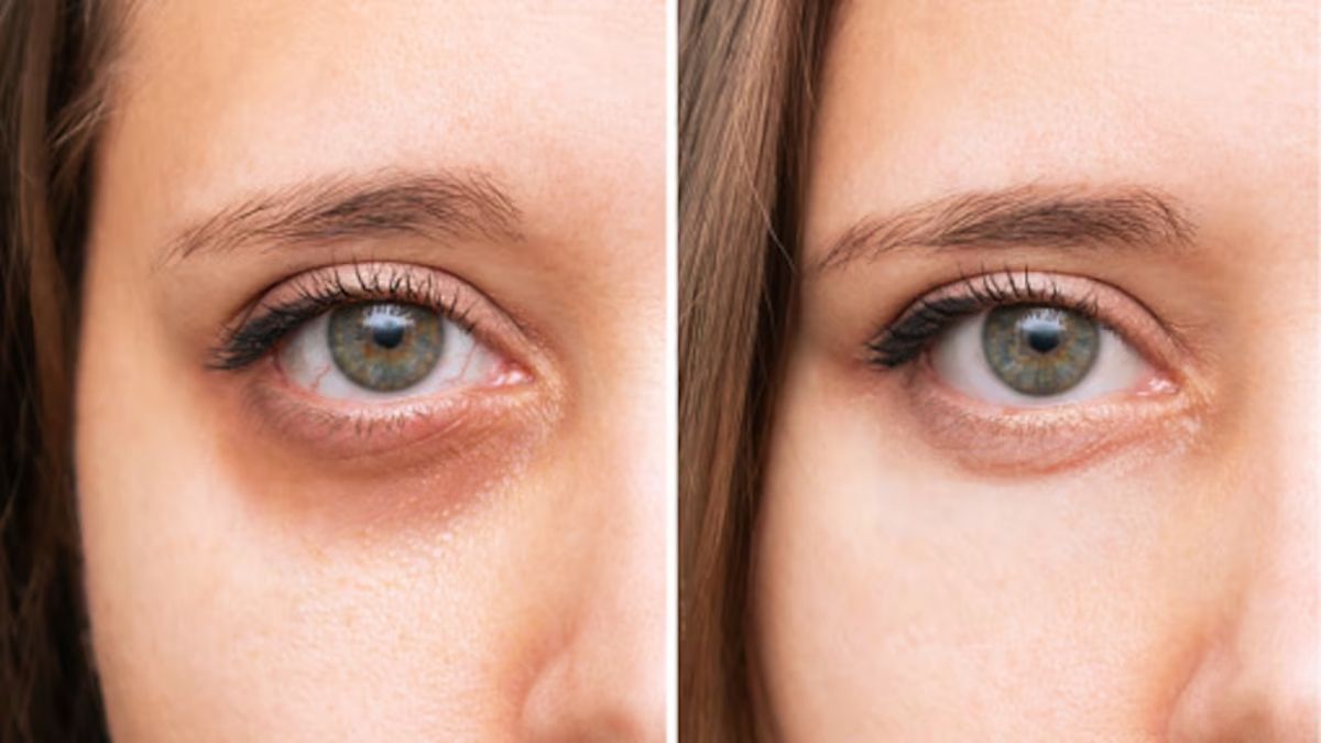 El alto contenido de almidón y el efecto frío de la patata rallada ayudan a drenar los líquidos acumulados