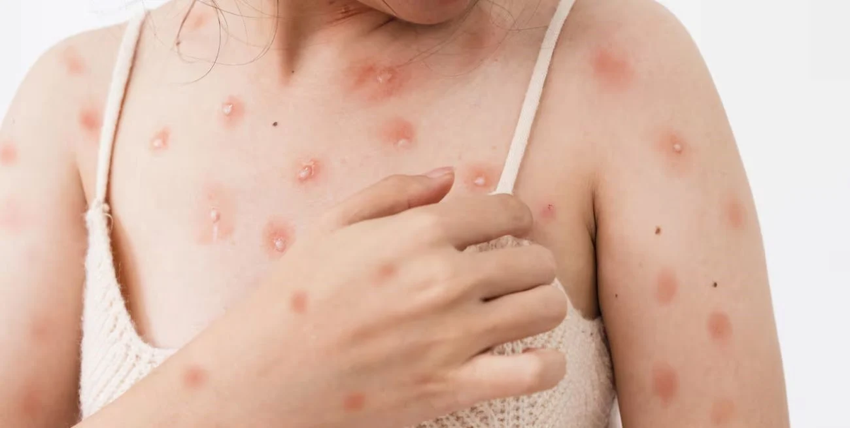 La viruela del mono se transmite principalmente a través del contacto físico cercano, particularmente durante la actividad sexual. La viruela del mono se transmite principalmente a través del contacto físico cercano, particularmente durante la actividad sexual.