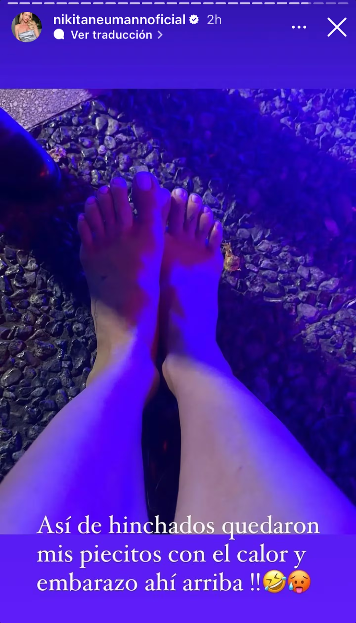 Neumann compartió a sus seguidores cómo le quedaron los pies. Neumann compartió a sus seguidores cómo le quedaron los pies.