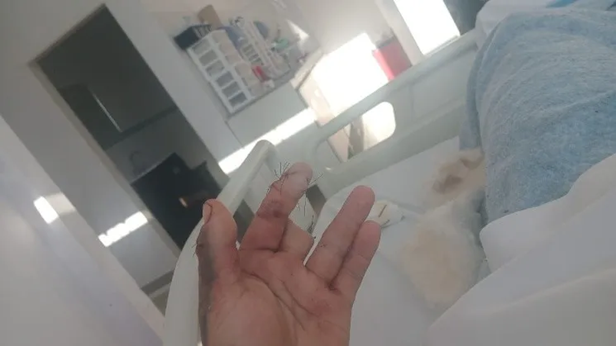 Mario fue hospitalizado con un dedo amputado, y continúa internado. Mario fue hospitalizado con un dedo amputado, y continúa internado.