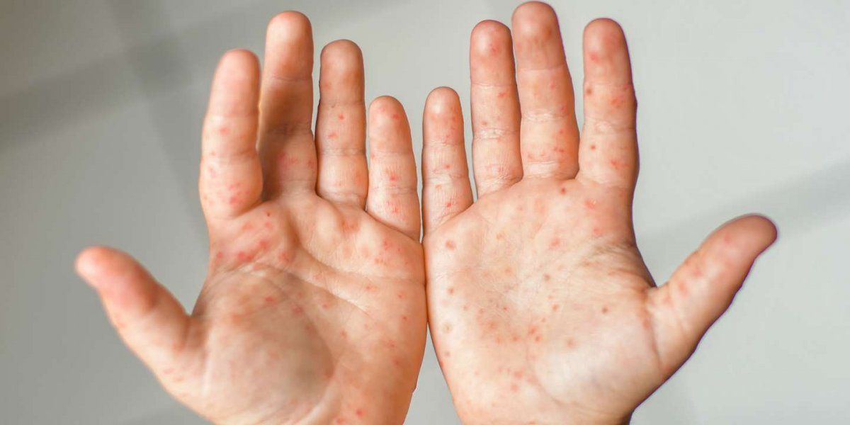 Alertan por casos de enfermedad de manos