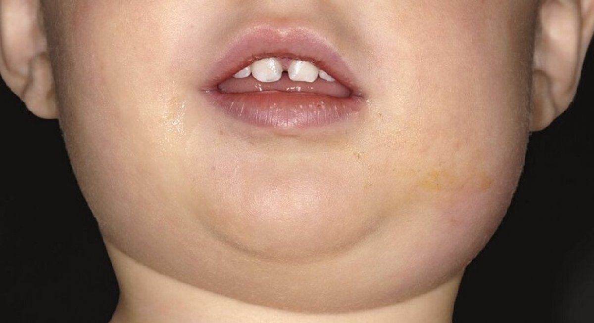 Le dijeron que su nene tenía paperas y que sólo tomara agua: terminó muerto