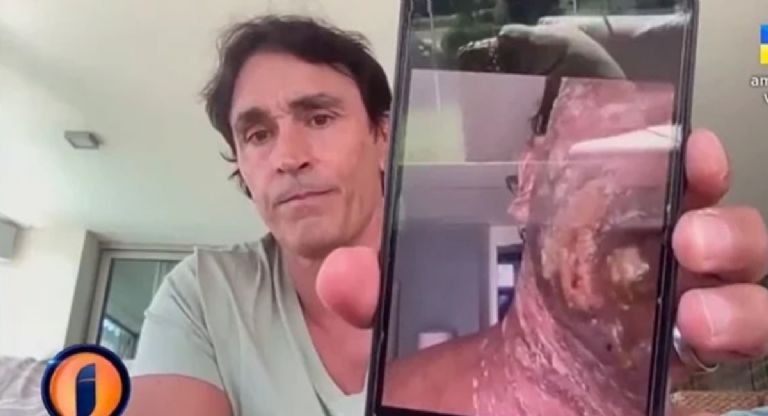 Así tenía la cara y el cuello Sebastián Estevanez.