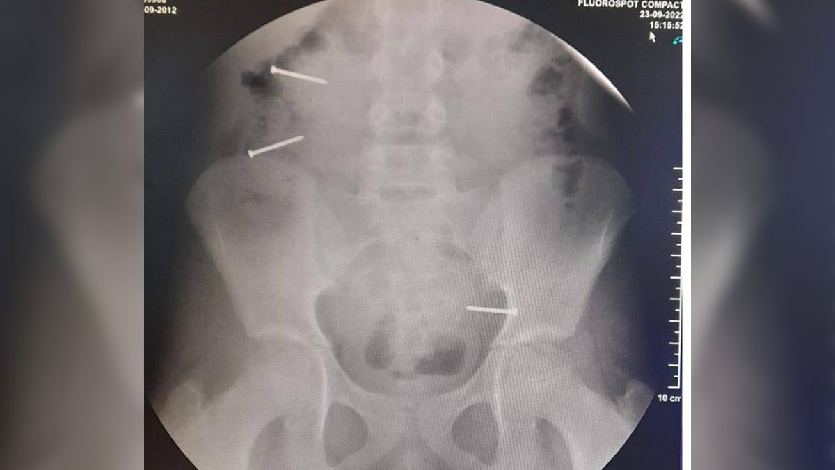 El peligroso reto viral que pone en vilo a los padres y madres: tragarse clavos y publicarlos en TikTok