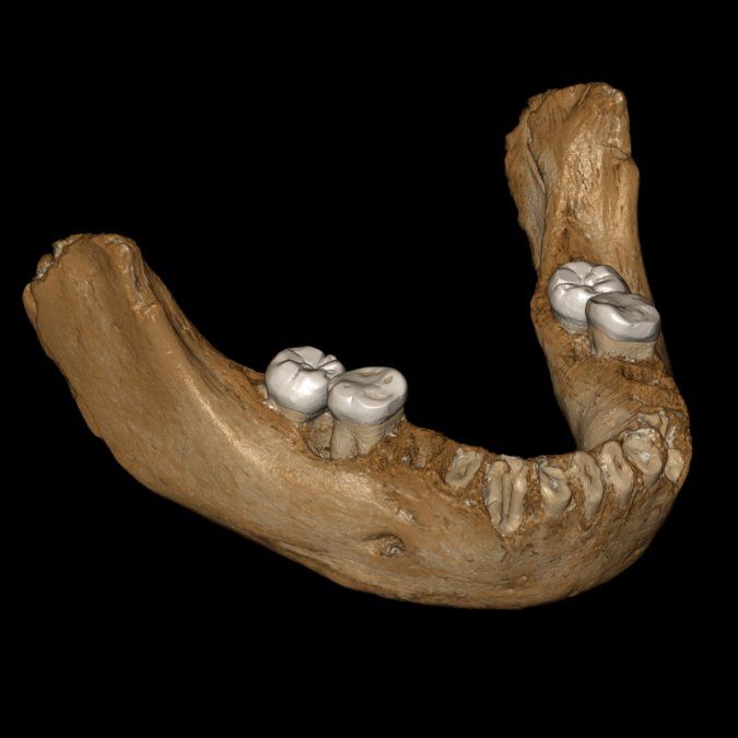 reconstruccion virtual de la mandibula_b532ab5b_1280x1280 e1556741987266.png