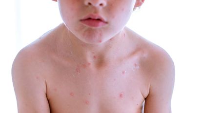 Alerta por brote de sarampión en Argentina: ya son cuatro los casos confirmados en CABA