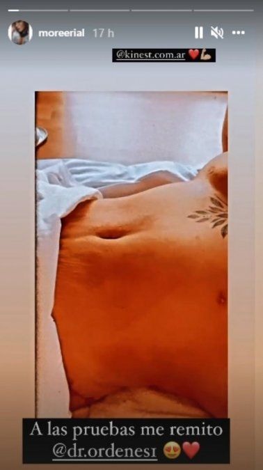 Así quedó More Rial tras su paso por el quirófano. 