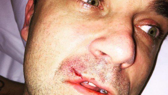 El insólito accidente que sufrió Robbie Williams