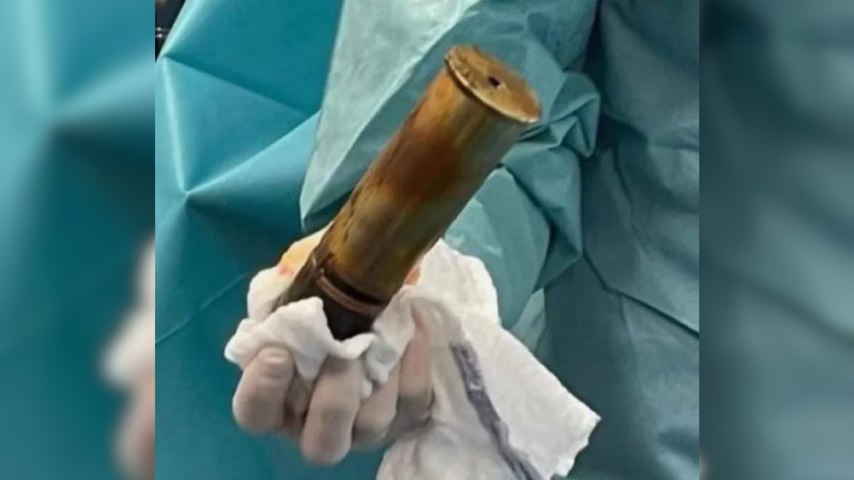 Evacúan hospital en Toulouse por proyectil de la Primera Guerra Mundial alojado en un paciente