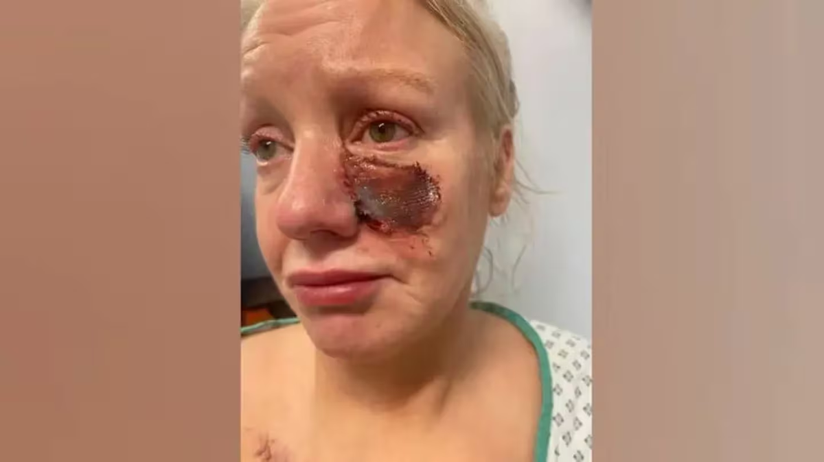 La mujer atacada por un perro salchicha debió ser intervenida quirúrgicamente. La mujer atacada por un perro salchicha debió ser intervenida quirúrgicamente.