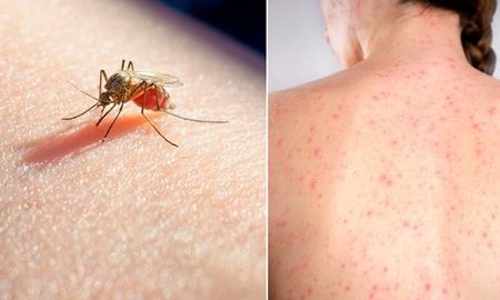 confirman 680 casos de dengue autoctono y 156 de sarampion confirman 680 casos de dengue autoctono y 156 de sarampion