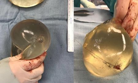 La muestra de los implantes de siliconas que le salvaron la vida. La muestra de los implantes de siliconas que le salvaron la vida.