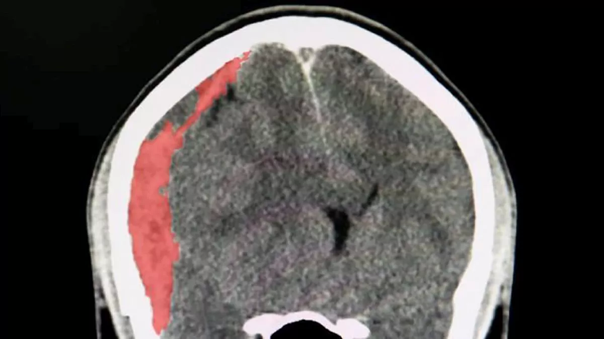Hematoma subdural agudo. Hematoma subdural agudo.