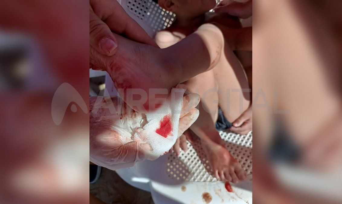 Las lesiones por palometas en niños pueden ser más graves que en adultos, indicaron desde el Sindicato de Guardavidas.