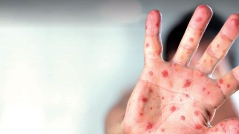 Alarma por un brote récord de sarampión en Europa