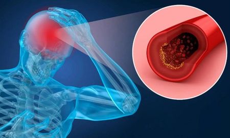 Dolor fuerte de cabeza y adormecimiento en las extremidades, son algunos de los síntomas que puede provocar una ACV. Dolor fuerte de cabeza y adormecimiento en las extremidades, son algunos de los síntomas que puede provocar una ACV.