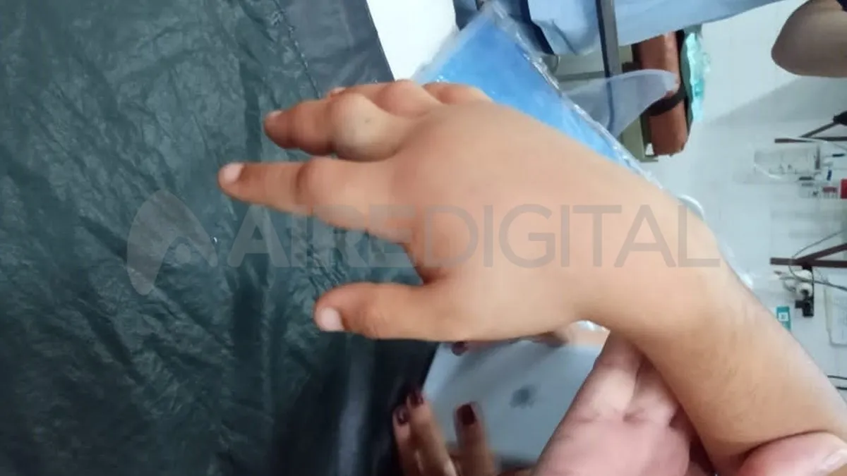 Giovani fue picado por una víbora Yarará el domingo a la tarde. 