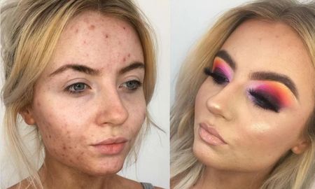 Tiene un extraño acné y ayuda a otros a aceptar sus problemas en la piel: “Es difícil ver qué es real en Instagram”