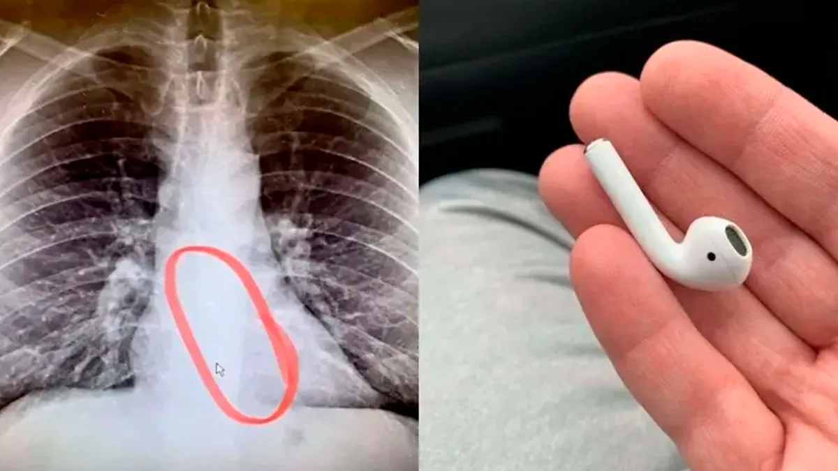 El AirPod que se quedó en su organismo.