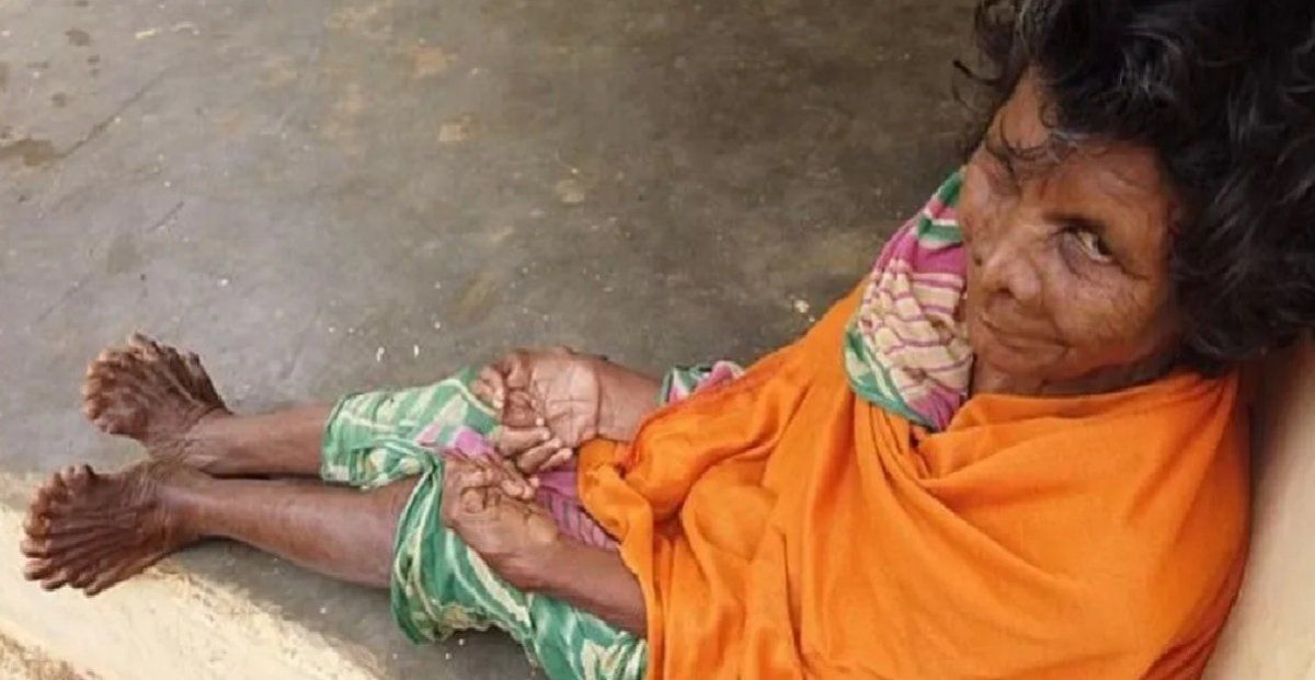 Qué es la polidactilia, el trastorno genético que acosa a esta mujer y la transformó en bruja