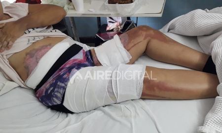 La mujer presenta graves quemaduras en su abdomen y las piernas La mujer presenta graves quemaduras en su abdomen y las piernas