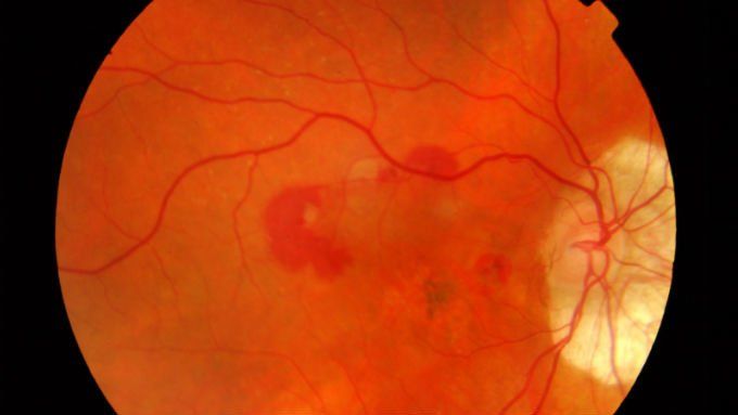 Algunos de los síntomas frecuentes de la DMRE son la distorsión, es decir que las líneas rectas pueden parecer onduladas o dobladas; visión borrosa o dificultad para leer o hacer cualquier otra actividad que requiera detalles en la visión central