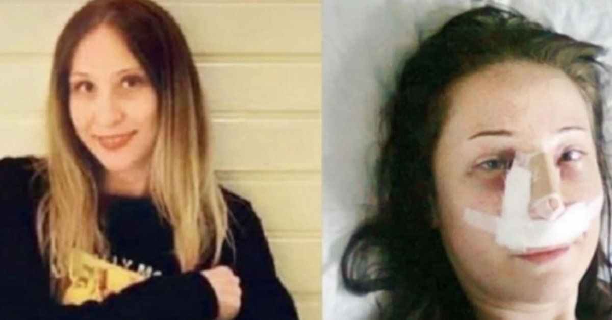 Fue a un hospital a operarse la nariz y le amputaron las dos piernas por un error