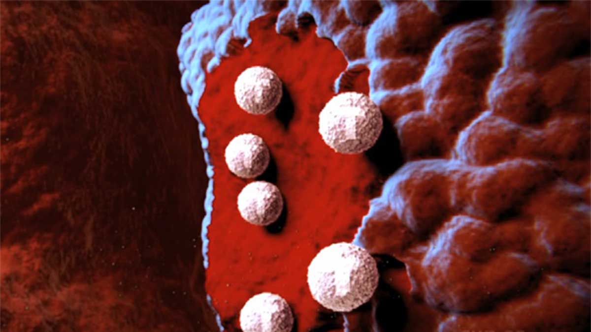 El nuevo tratamiento combina una inmunoterapia -el atezolizumab- con un anticuerpo monoclonal -el bevacizumab-. 