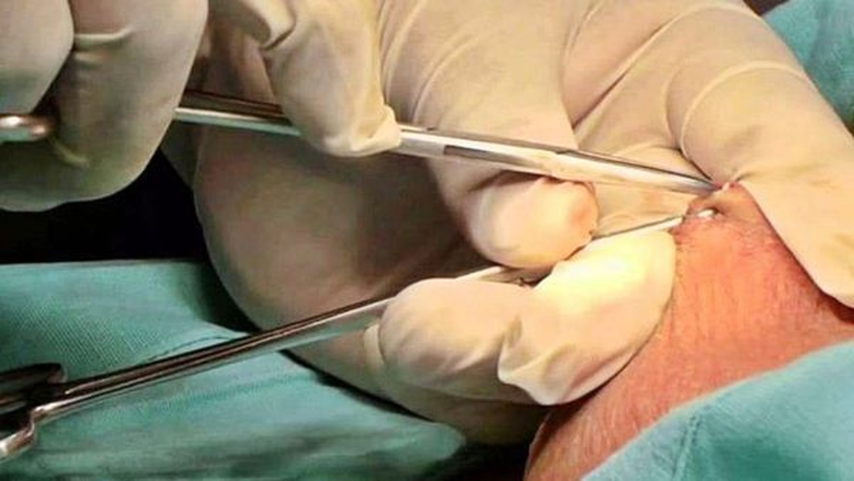 La vasectomía o deferentectomía es un método anticonceptivo masculino o de control natal que consiste en una intervención quirúrgica ambulatoria, o bien bajo la modalidad sin bisturí.