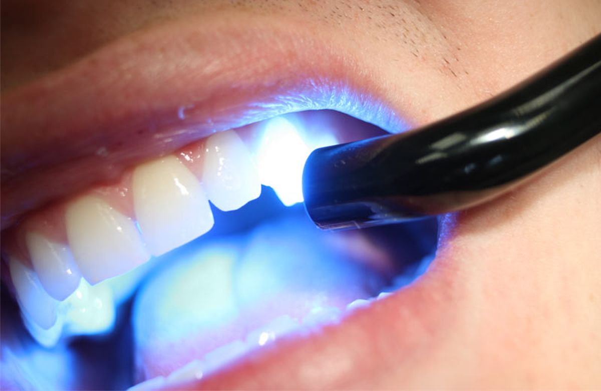 El metacrilato es una sustancia plástica utilizada para prótesis dentales y óseas.