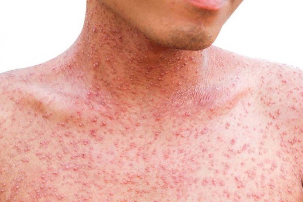 Vizzotti recordó que la vacuna contra el sarampión está en calendario al año de vida y al ingreso escolar