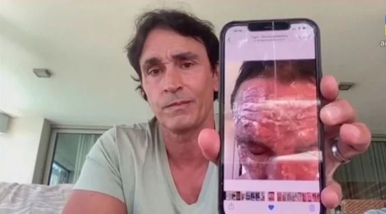 Estevanez dijo que cuando los médicos y su familia quedaron en shock cuando lo vieron quemado. "Era un monstruo", afirmó.