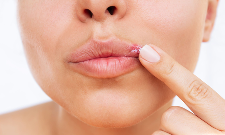 herpes labial: que lo causa y como aliviar el dolor herpes labial: que lo causa y como aliviar el dolor