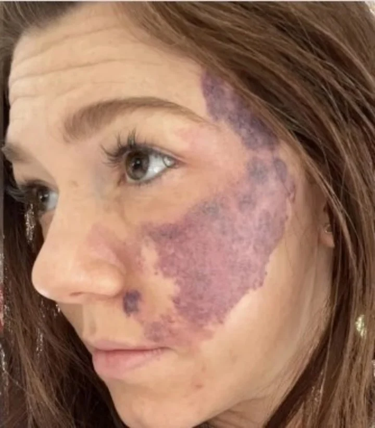 Emily Hallett nació con una marca de nacimiento que cubre casi la mitad de su rostro (Bol News).