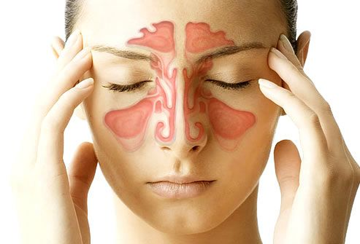 La sinusitis es una infección de los senos nasales. Los senos paranasales son cavidades pequeñas y vacías detrás de las mejillas y la frente.