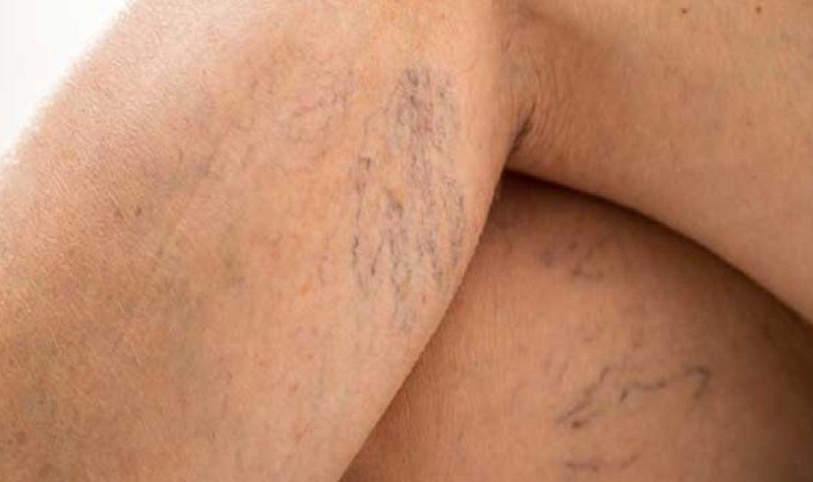 Varices en las piernas.