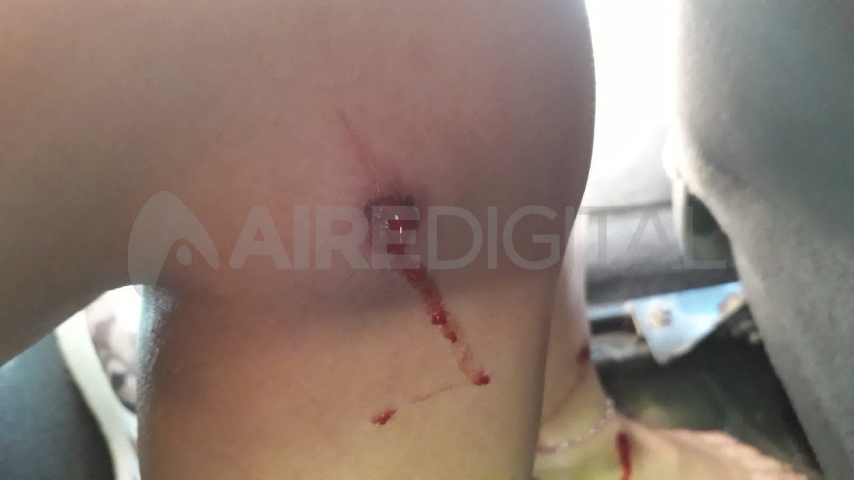 Así le quedaron las piernas a la joven de 20 años que fue asistida en el Hospital Cullen.