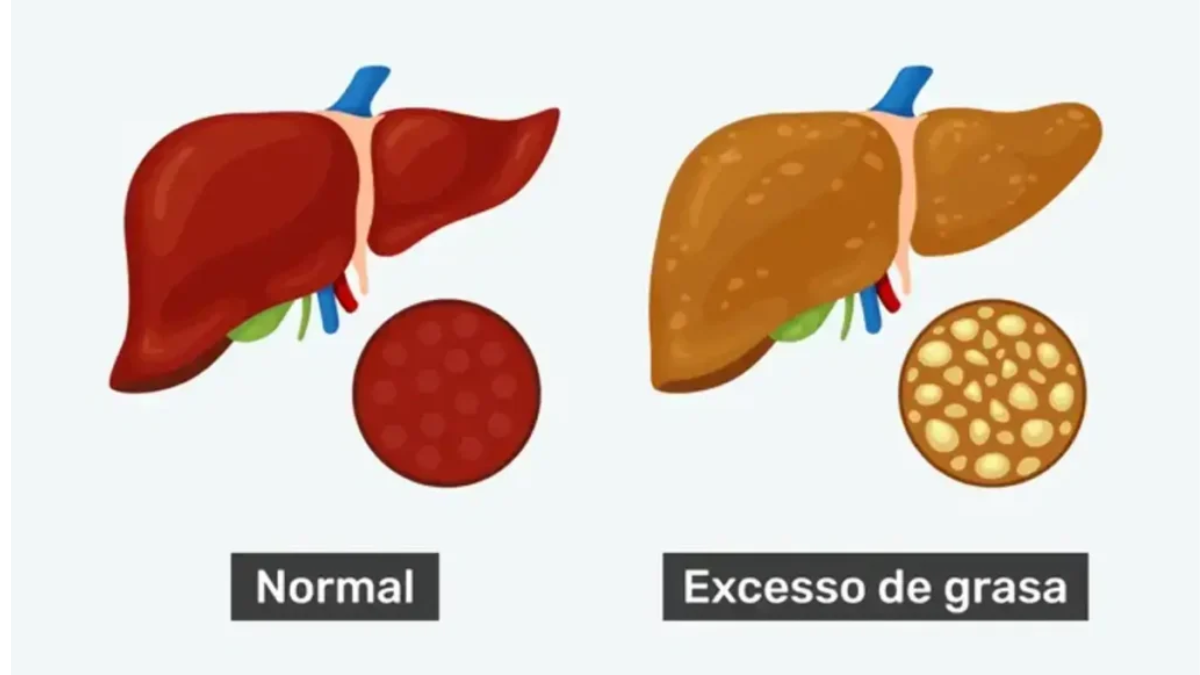 Los nuevos tratamientos farmacológicos para el MASH representan una esperanza concreta para revertir la fibrosis en pacientes con estadios avanzados..