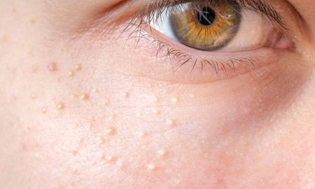 Es una zoonosis viral causada por el virus de la viruela símica, que pertenece al género Orthopoxvirus, este incluye al virus variola (causante de la viruela). Es una zoonosis viral causada por el virus de la viruela símica, que pertenece al género Orthopoxvirus, este incluye al virus variola (causante de la viruela).