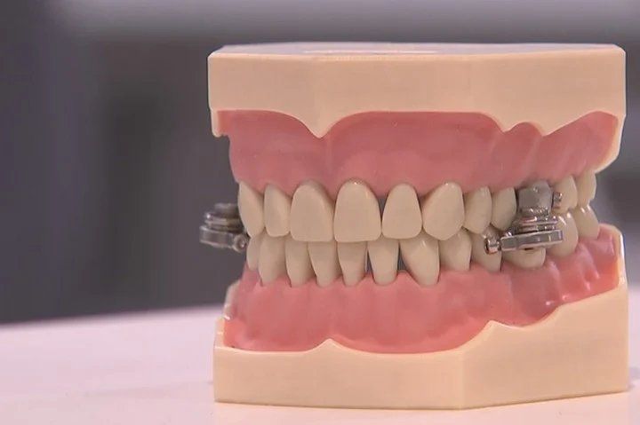Consta de bandas metálicas de acero inoxidable, imanes, cemento de ortodoncia a base de ionómero de vidrio y pernos. El dispositivo permite al usuario abrir la boca solo unos 2 milímetros (Universidad de Otago).