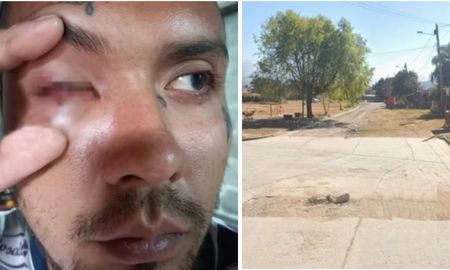 Un joven de Jujuy perdió un ojo luego de recibir un disparo por parte de un policía. Un joven de Jujuy perdió un ojo luego de recibir un disparo por parte de un policía.
