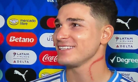 Copa América: qué le pasó en el cuello a Julián Álvarez Copa América: qué le pasó en el cuello a Julián Álvarez