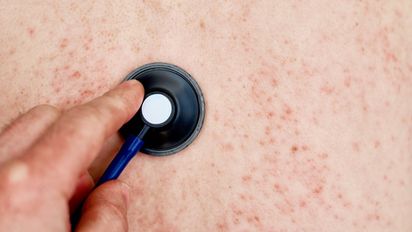 Sarampión en Argentina: por qué reaparece y cómo prevenir nuevos brotes