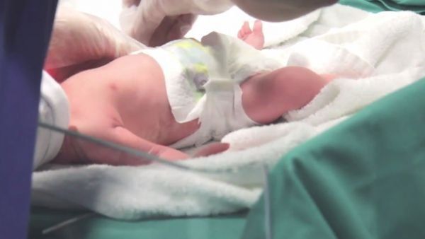 El caso de la bebé que nació “embarazada” de su hermano gemelo