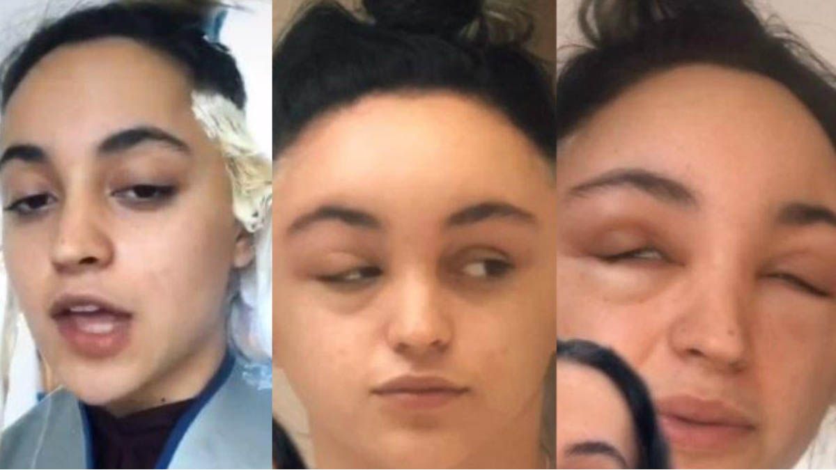 Una joven casi pierde la vida tras pintarse el cabello