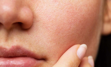 el bicarbonato un remedio natural beneficioso para las rojeces de la piel el bicarbonato un remedio natural beneficioso para las rojeces de la piel