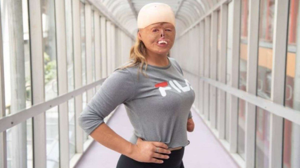 A los siete meses se quemó el 88% del cuerpo y no se resigna a cumplir su gran sueño: Quiero ser modelo